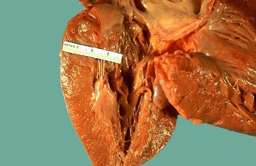 Cardiovascular Pathology